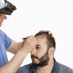A Single Hair Transplant Session for Achieving the Best Cosmetic Outcomes