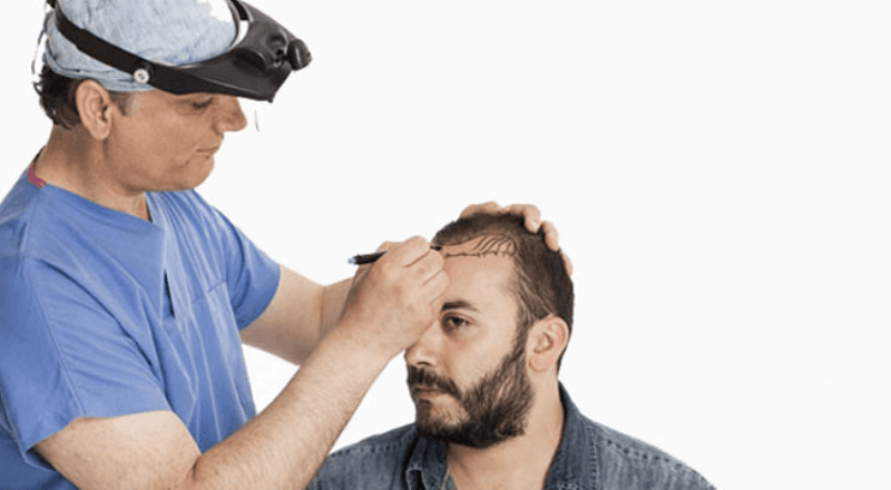 A Single Hair Transplant Session for Achieving the Best Cosmetic Outcomes