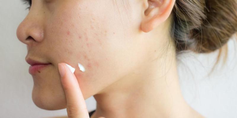 Causes Cure Acne Scars
