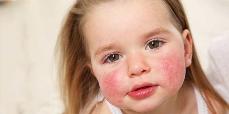 Yeast Infection Young Children