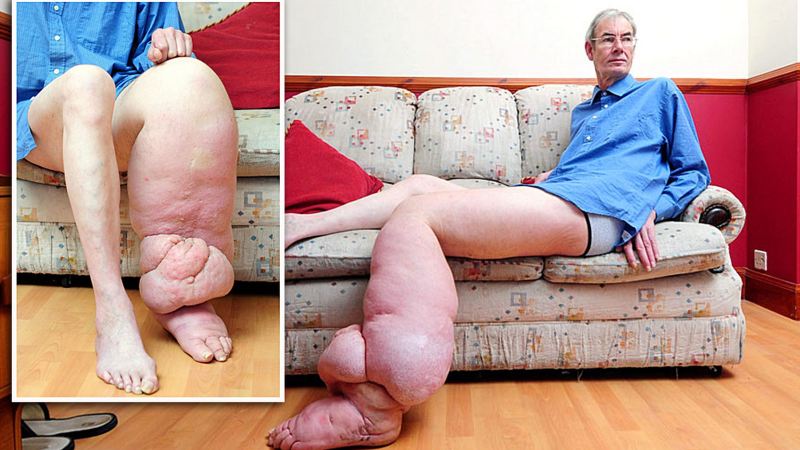 Lymphatic Filariasis - Causes, Symptoms and Treatment