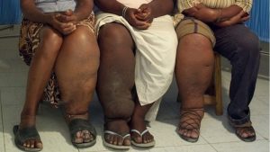 What is Scrotal Elephantiasis (SE)?