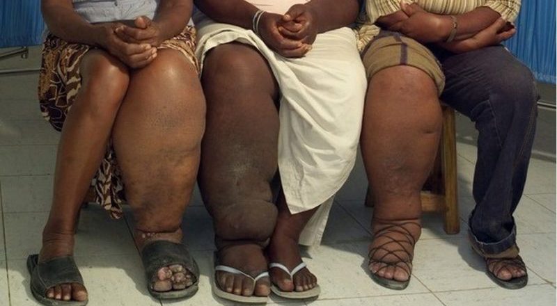 What is Scrotal Elephantiasis (SE)?