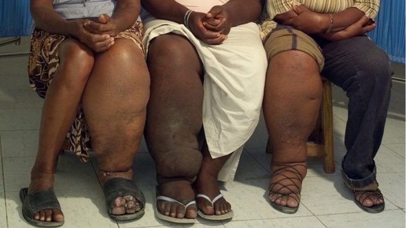 What is Scrotal Elephantiasis (SE)?