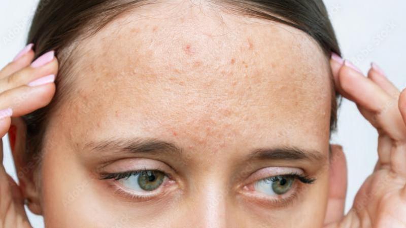 Forehead Acne Causes and Its Natural Treatment