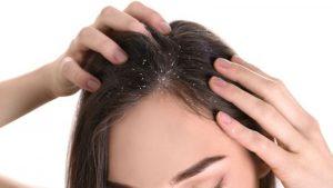 Scalp Psoriasis - The Things You Need To Know!