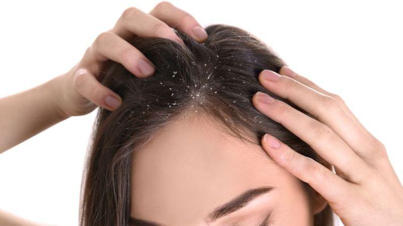 Scalp Psoriasis - The Things You Need To Know!