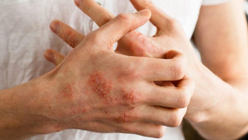 Latex Allergy - Causes, Symptoms & Treatment