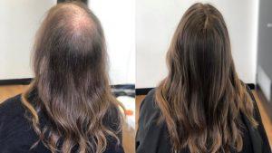 Some of the Aspects that You Need to Follow When You Need the Best Hair Loss Treatment