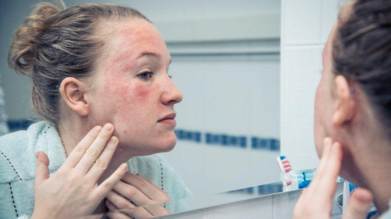 Simple Tips to Treat Eczema on Face